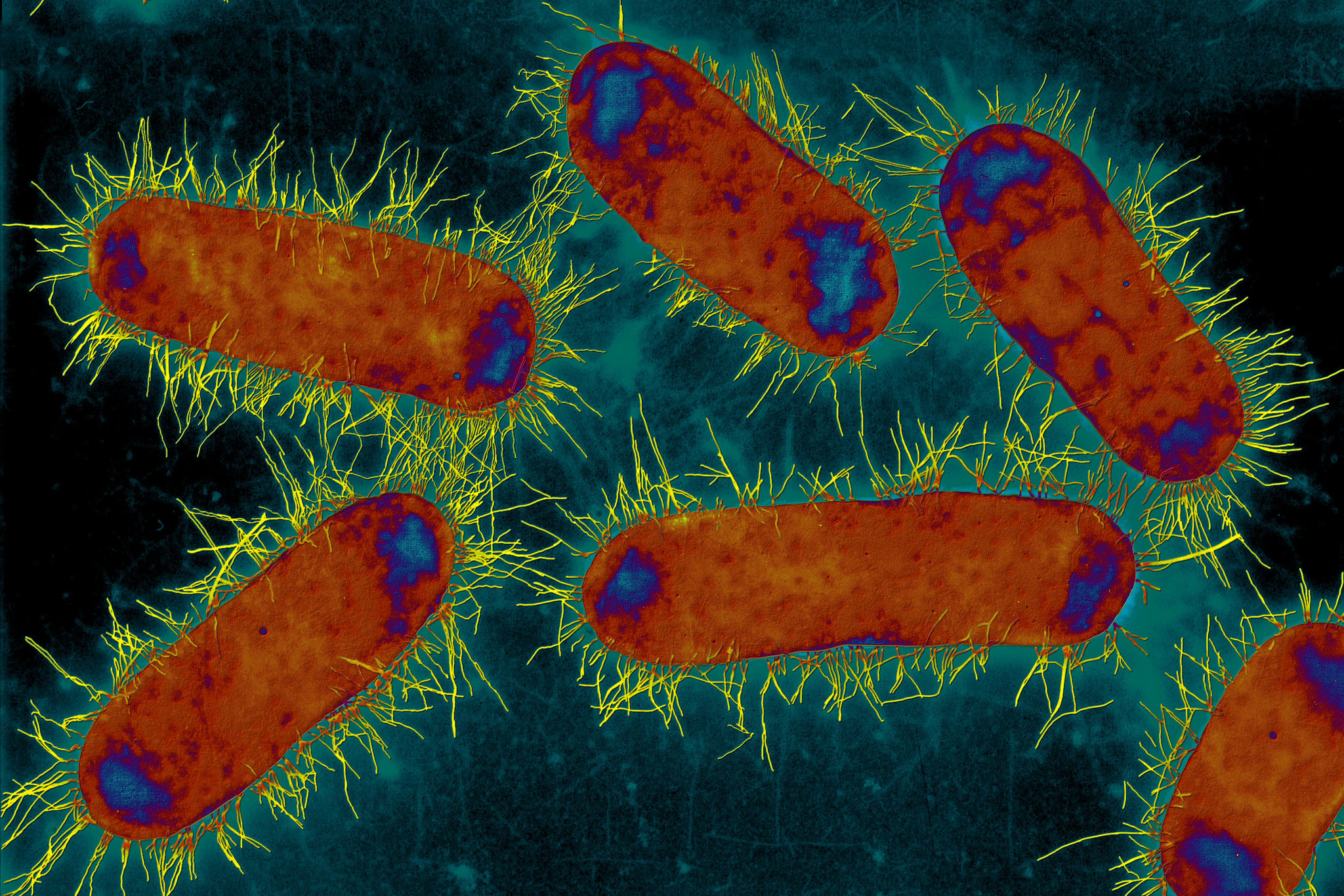 این تصویر عفونت ادراری مقاوم به آنتی بیوتیک است